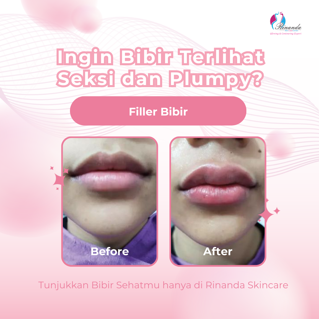 filler bibir terbaik di jakarta