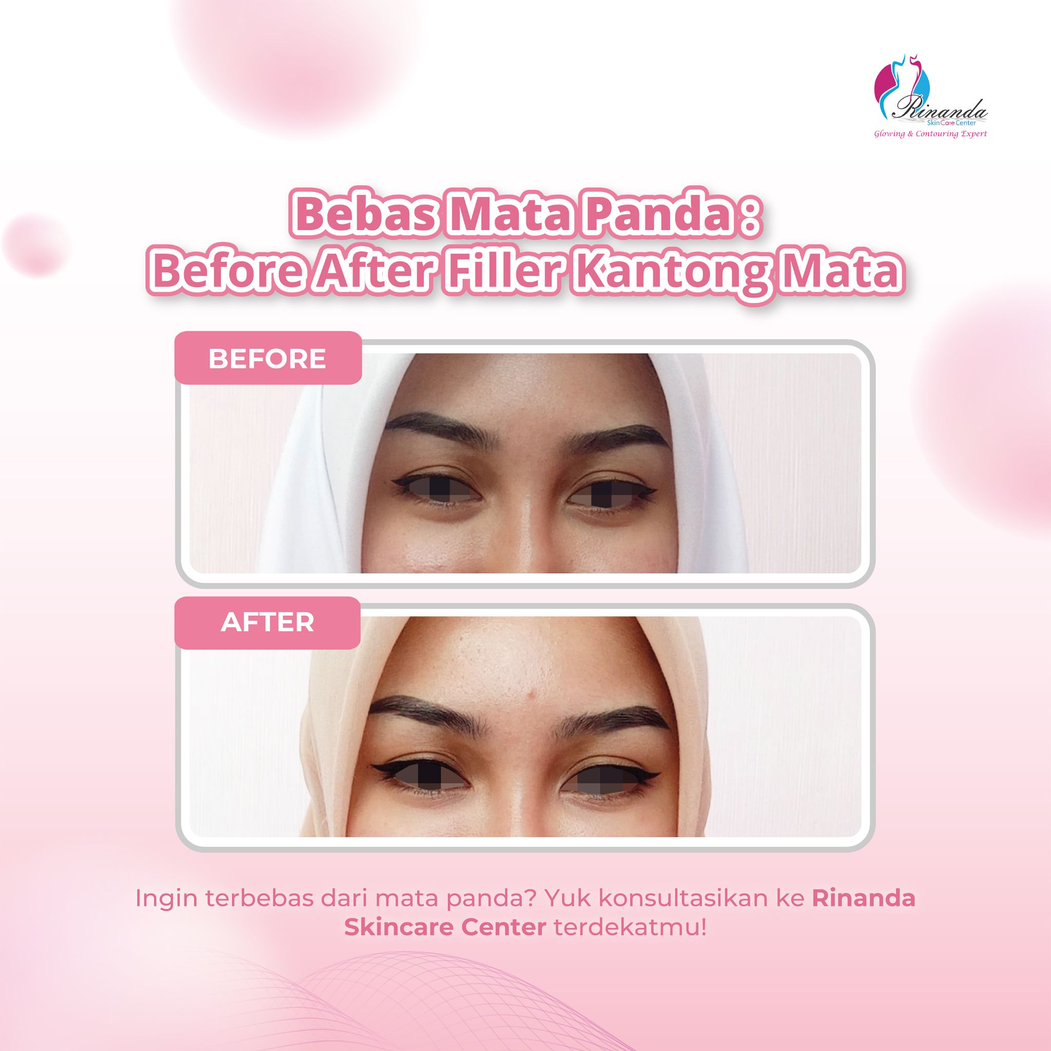 filler kantung mata terbaik di jakarta