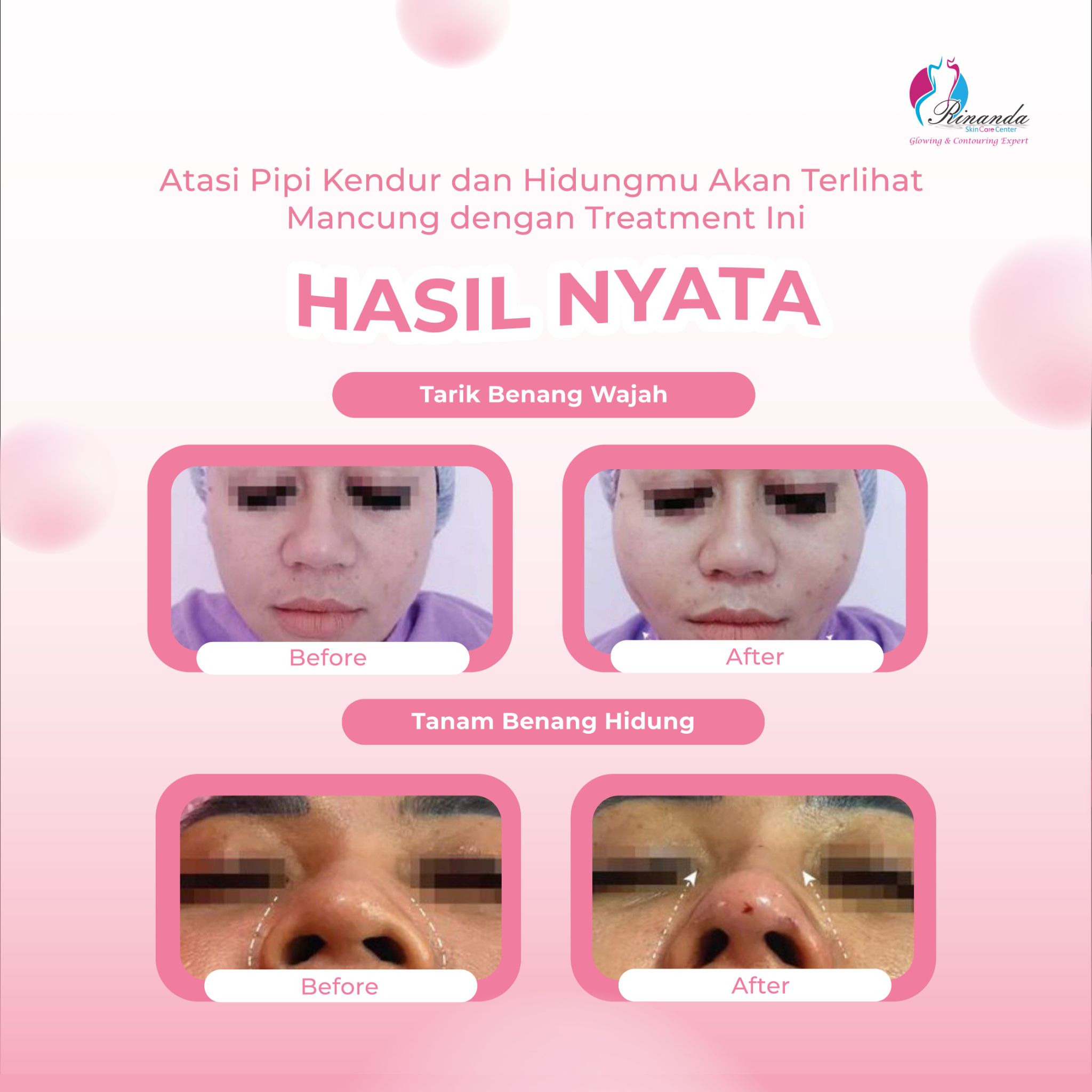testimoni tanam benang hidung